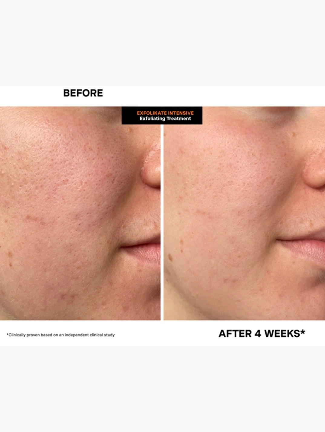 Alternative Image Kate Somerville Exfoli Kate Intensive Treatment
