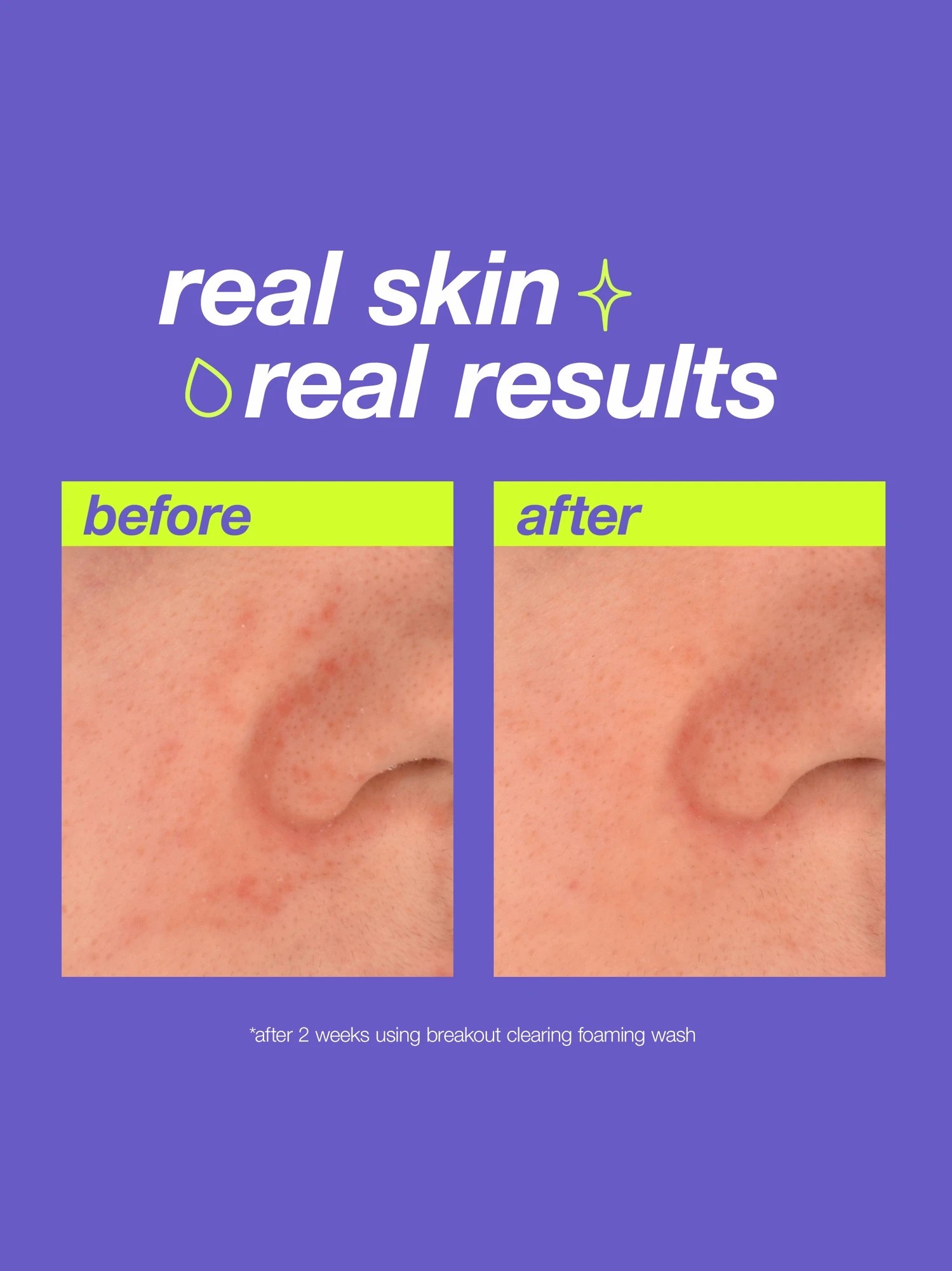 Alternative Image Dermalogica Clearstart Breakout Clearing Foaming Wash