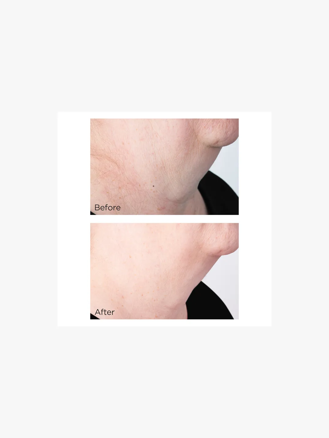 Alternative Image Perricone MD Cold Plasma Plus+ Sub D Neck