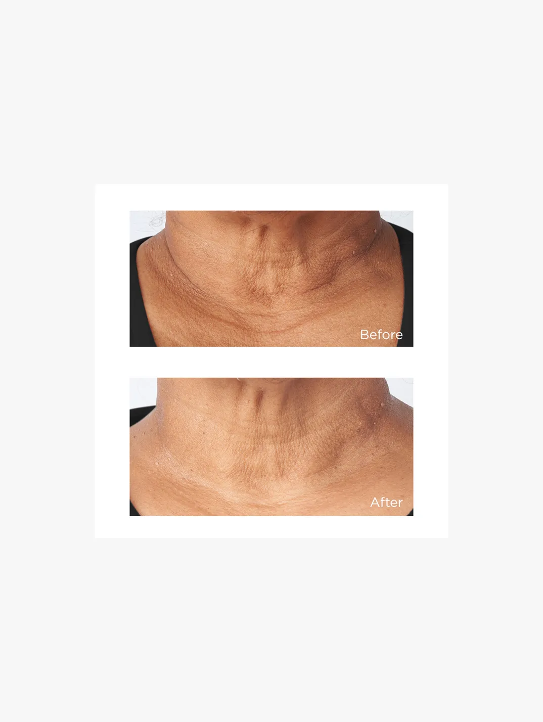 Alternative Image Perricone MD Cold Plasma Plus+ Sub D Neck