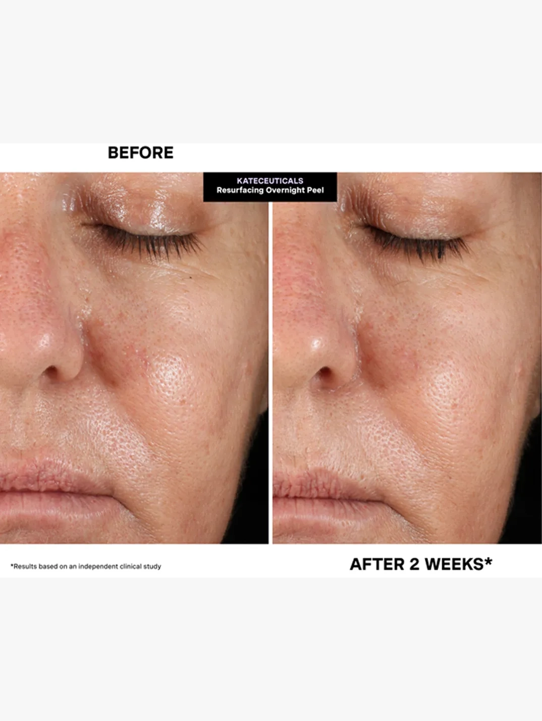 Alternative Image Kate Somerville Kate Ceuticals Resurfacing Overnight Peel