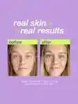 Alternative Image Dermalogica Post Breakout Fix