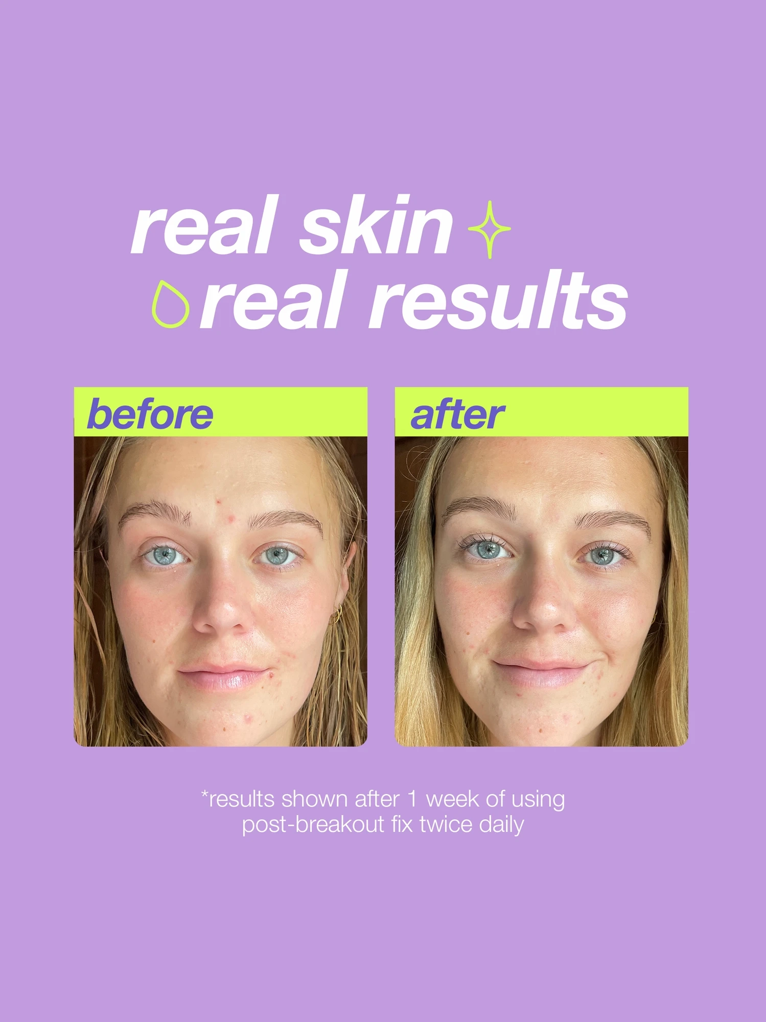 Alternative Image Dermalogica Post Breakout Fix
