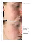 Alternative Image ALLIESOFSKINMULTIACIDRETINOIDFACIAL