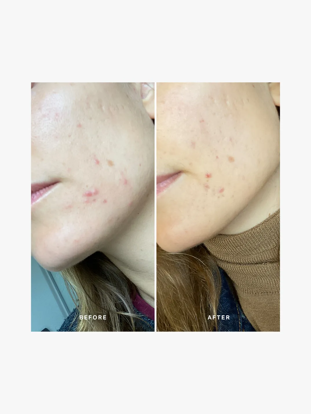 Alternative Image Alpha H Instant Action BHA Blemish Treatment