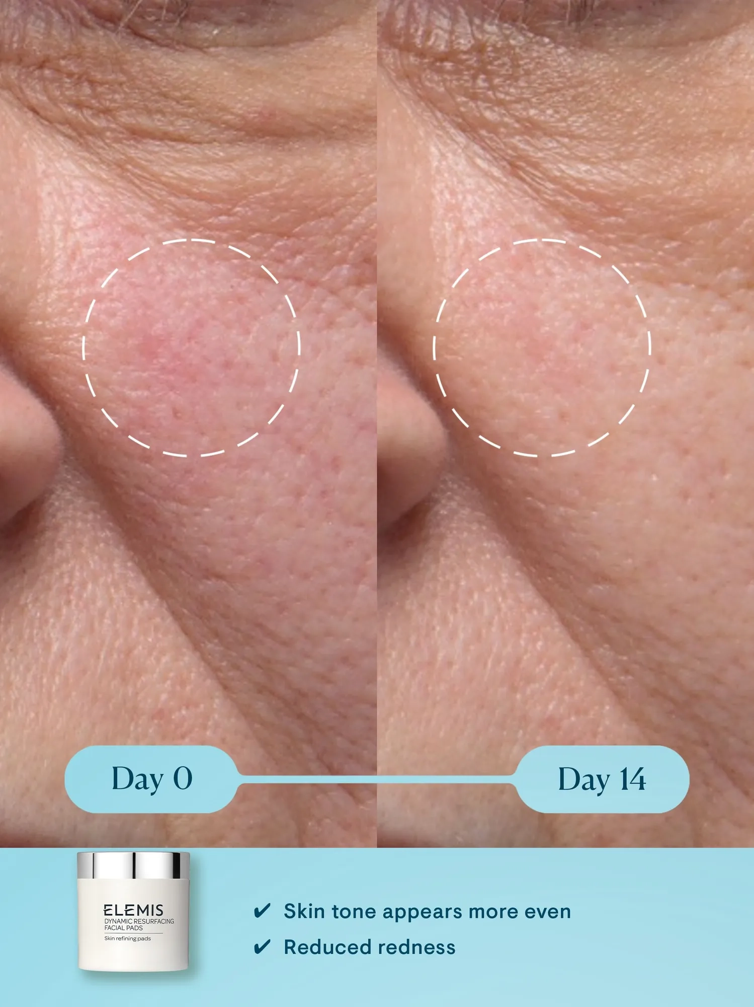 Dynamic Resurfacing Facial Pads