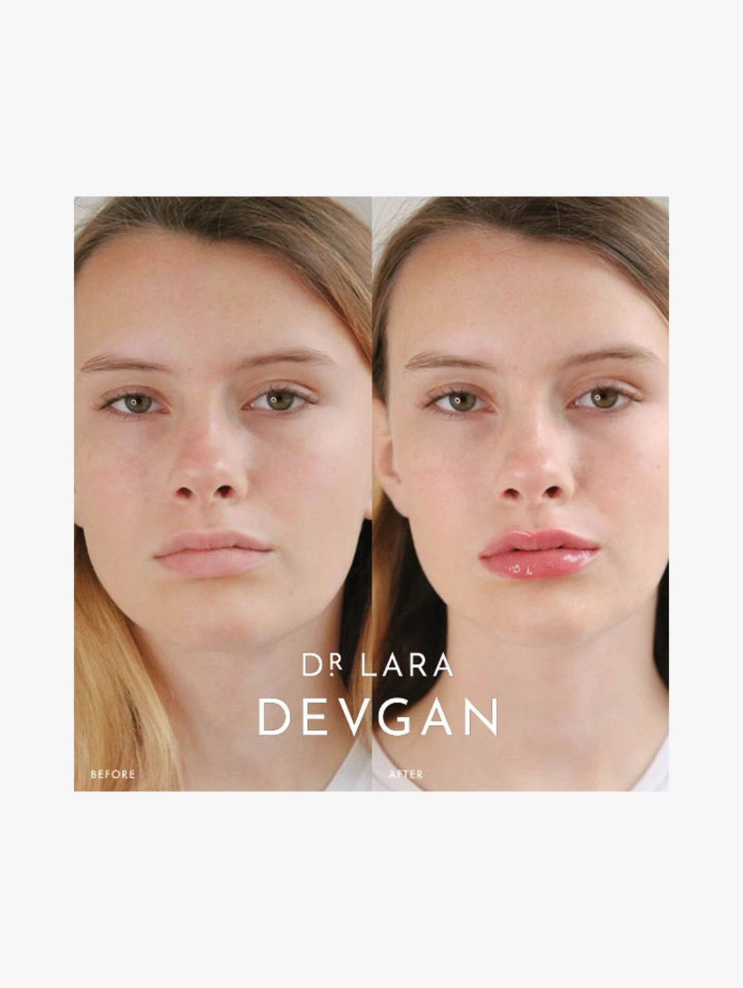Alternative Image Dr Lara Devgan Platinum Lip Plump