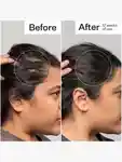 Alternative Image Act Acre Stem Cell Peptide Scalp Treatment