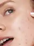 Memo Guide To Adult Acne Thumbnail Portrait 3x4